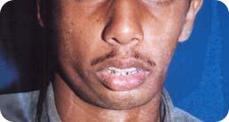 asymmetry_of_face1
