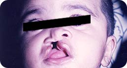 cleft_lip_correction1